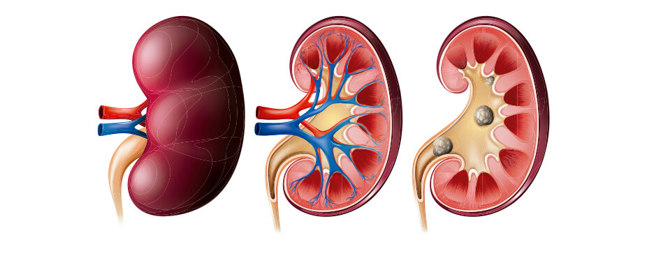 Imagem Cálculo Renal